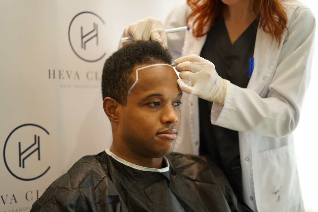 before hair transplant at heva clinic