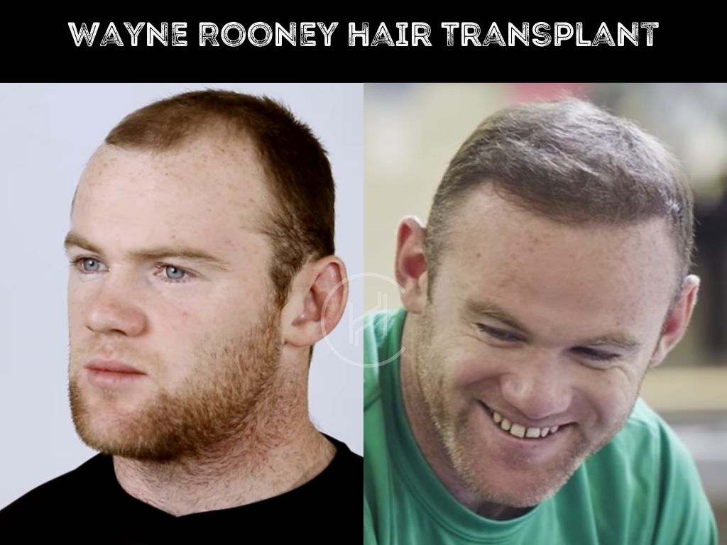 3000+ grafts hair transplant before and after photo Wayne Rooney