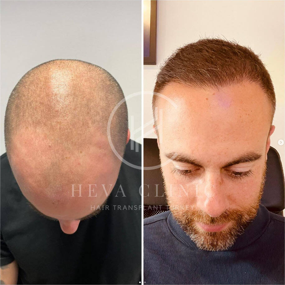 3700 graft hair transplant at heva clinic