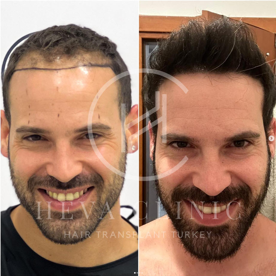 8 months 3000 grafts hair transplant before and after result