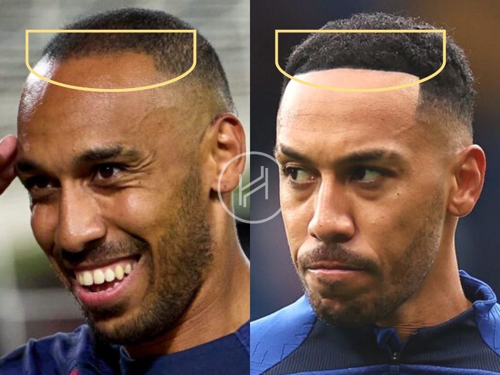 Aubameyang Hair Transplant Before and After