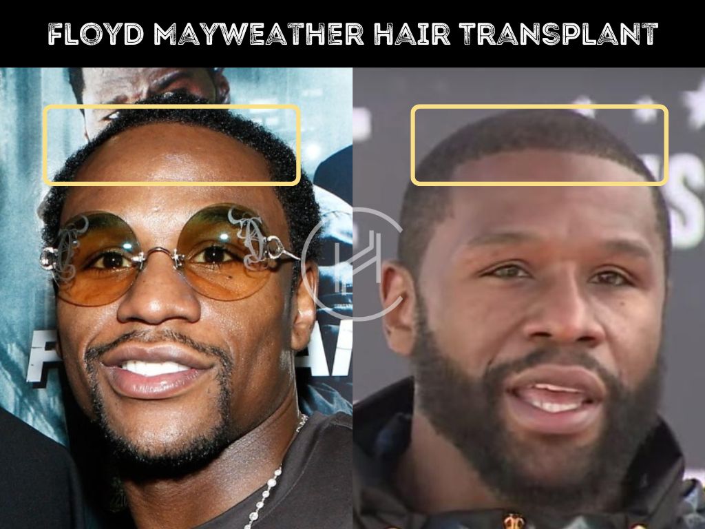 Before and after Floyd Mayweather hair transplant photo