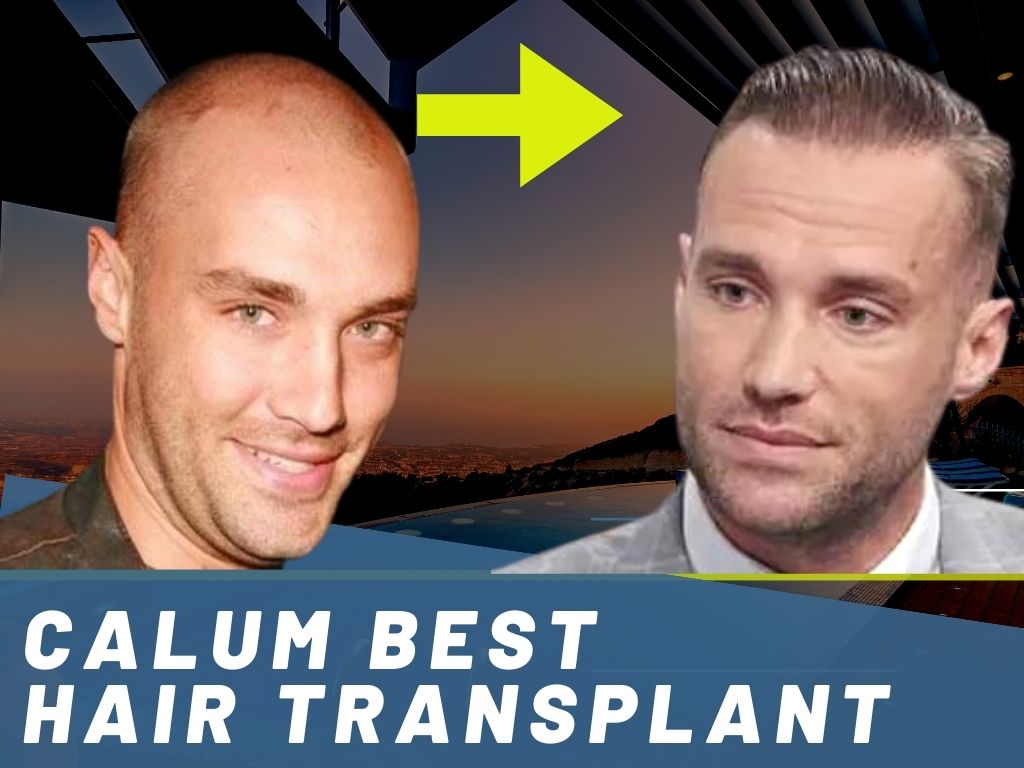 Calum Best Hair Transplant Analysis Banner