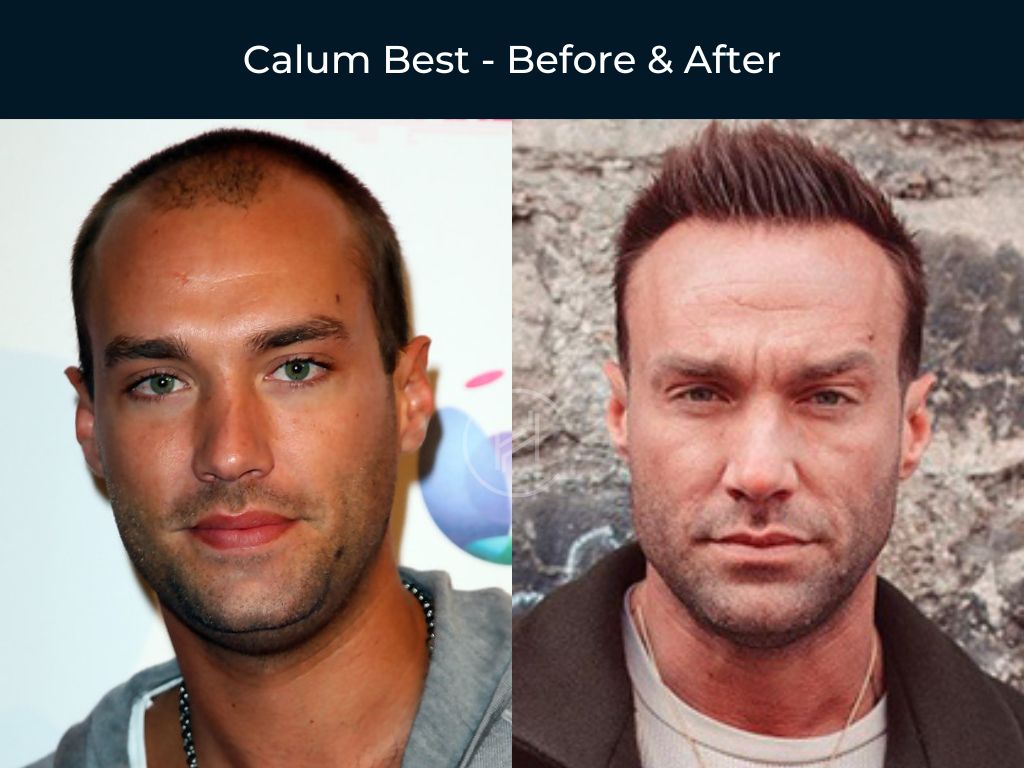 Ben Affleck Before After Hair Transplant