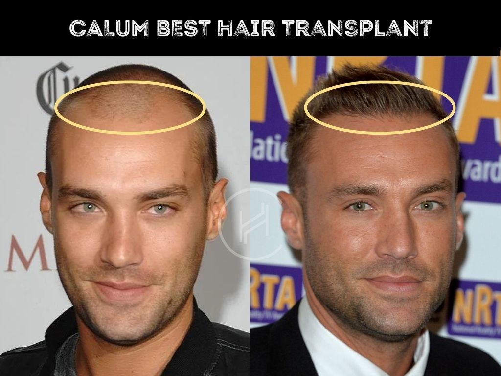 Calum Best Hair Transplant Before and After