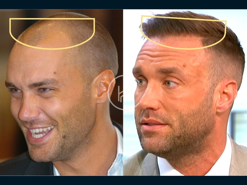 Calum Best Hair Transplant Hairline Before and After