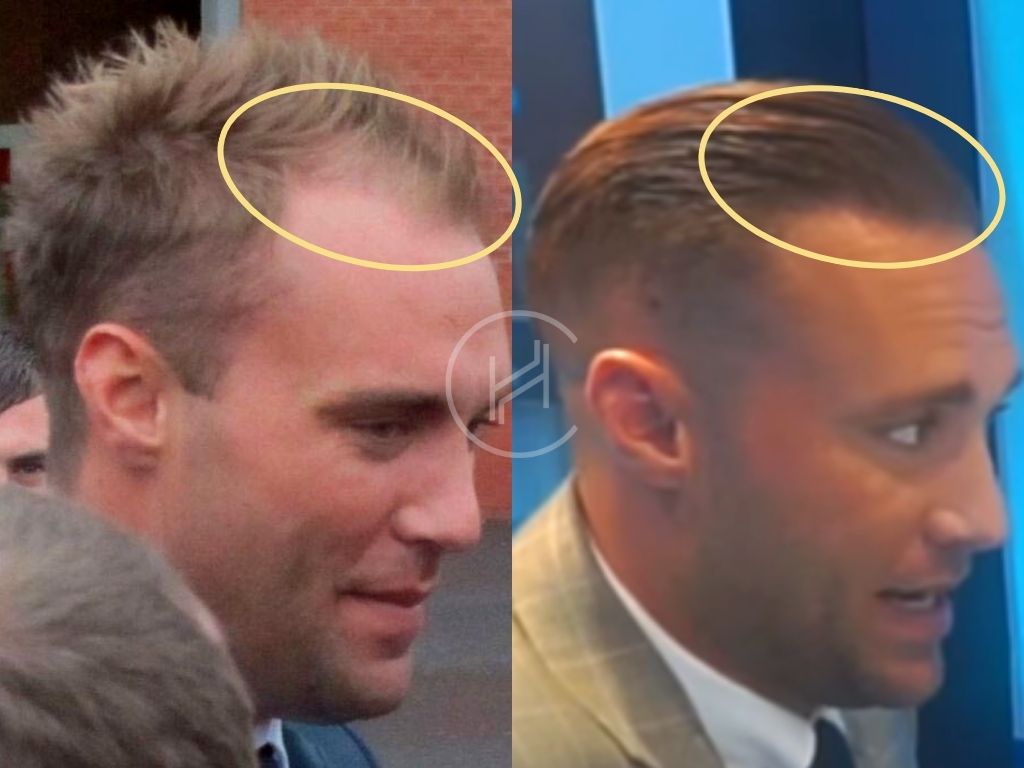 Calum Best Hair Transplant Result Before and After Photo