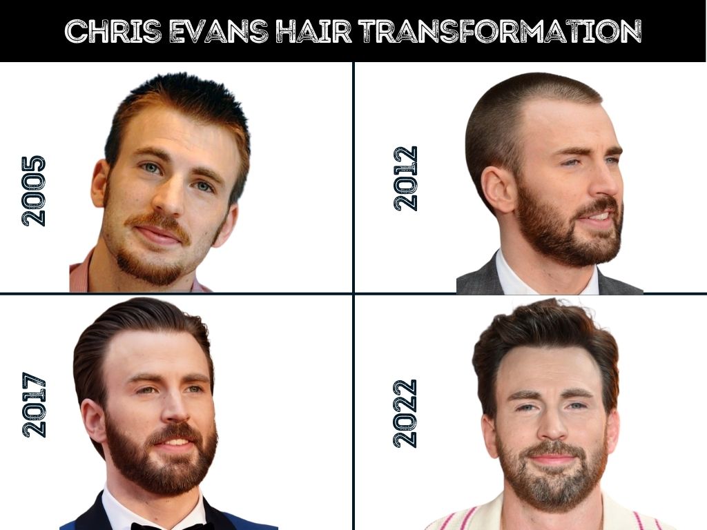 Chris Evans Hair Loss and Hair Transformation