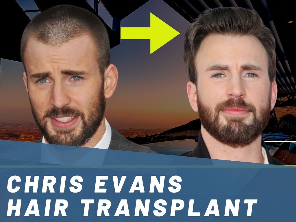 Chris evans hair plugs