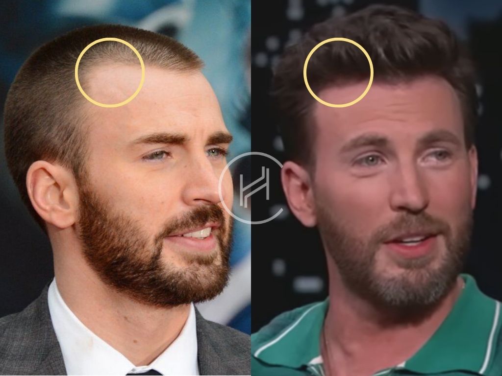 Chris Evans Hair Transplant Hairline Before and After Photo