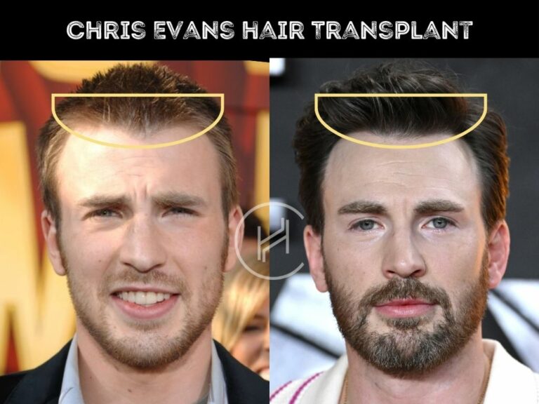 Chris Evans Hair Transplant - Hair Loss & Technical Analysis