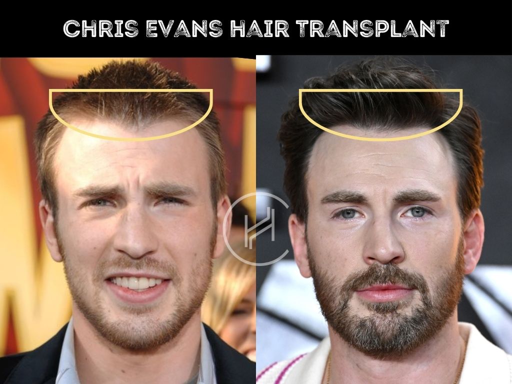 Chris Evans Hair Transplant Result Before & After