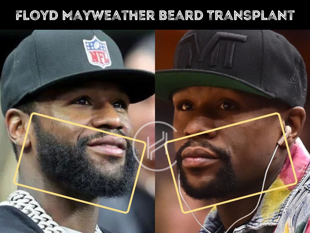 Floyd Mayweather Beard Transplant Before and After Result