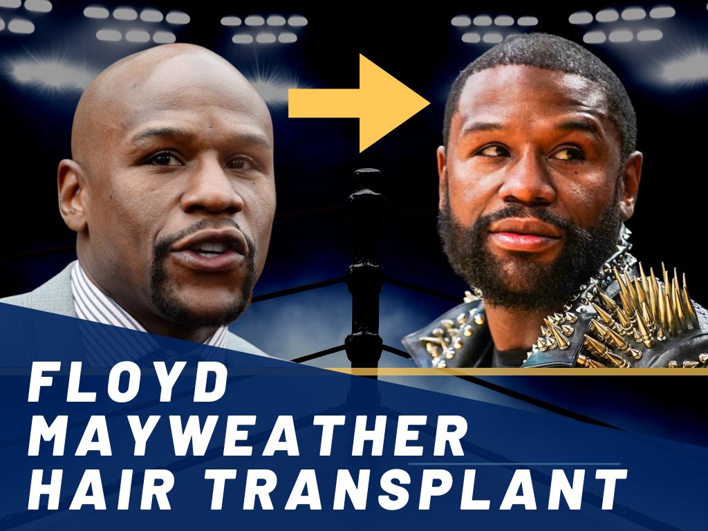 Floyd Mayweather Hair Transplant Before and After Banner