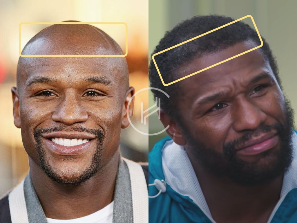 Floyd Mayweather Jr frontline hair transplant before and after
