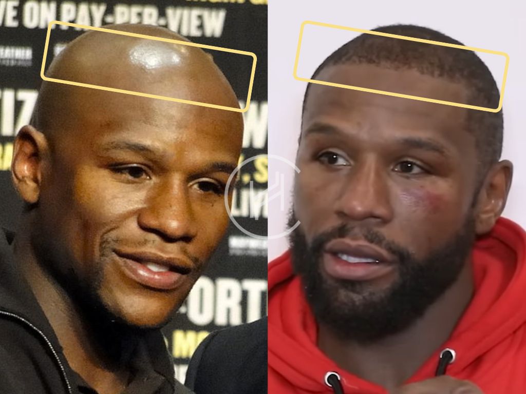 Floyd Mayweather hair transplant result before and after