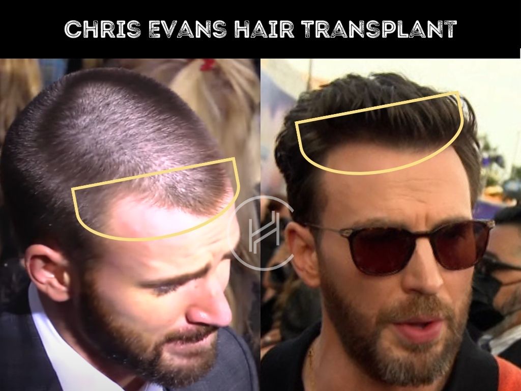 Hair Transplant Before After Chris Evans