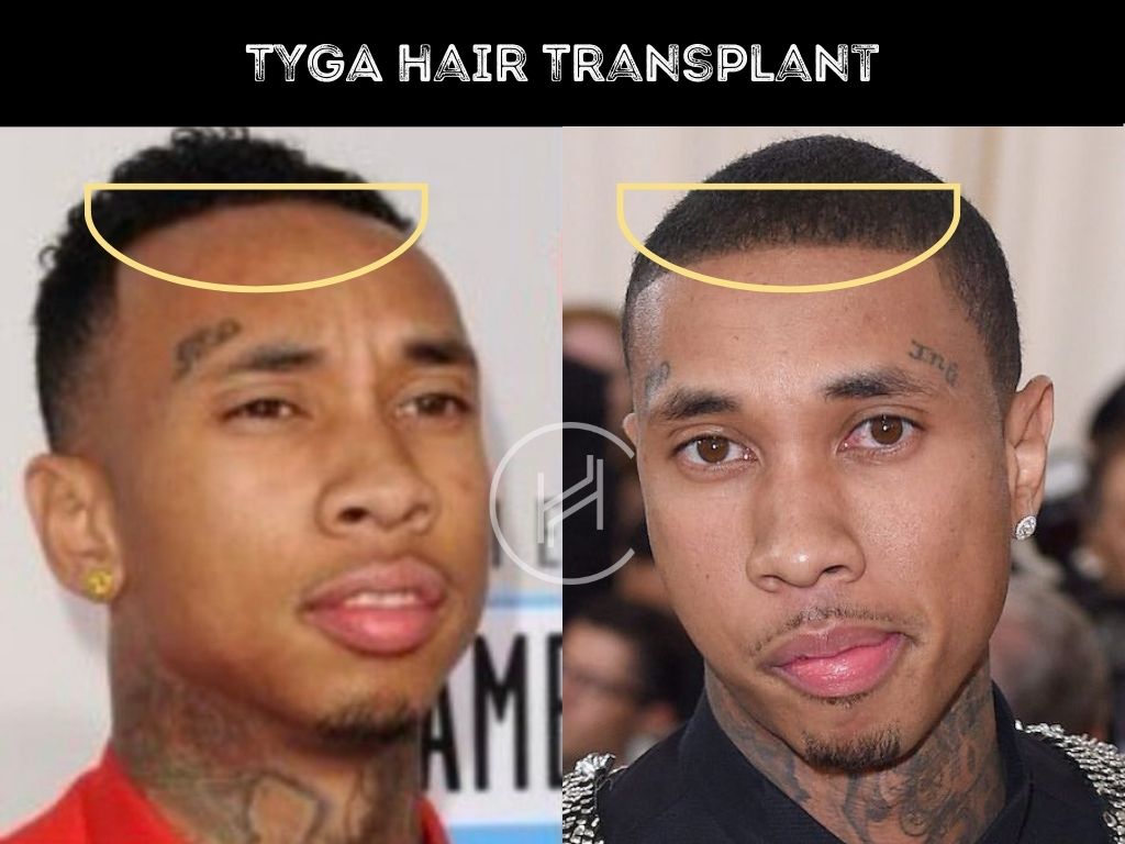 Hair Transplant Before and After Result Tyga