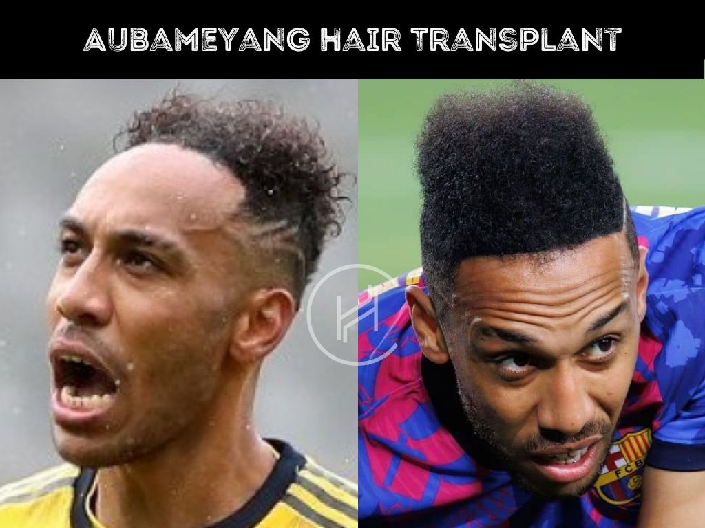 Hair Transplant Result Aubameyang