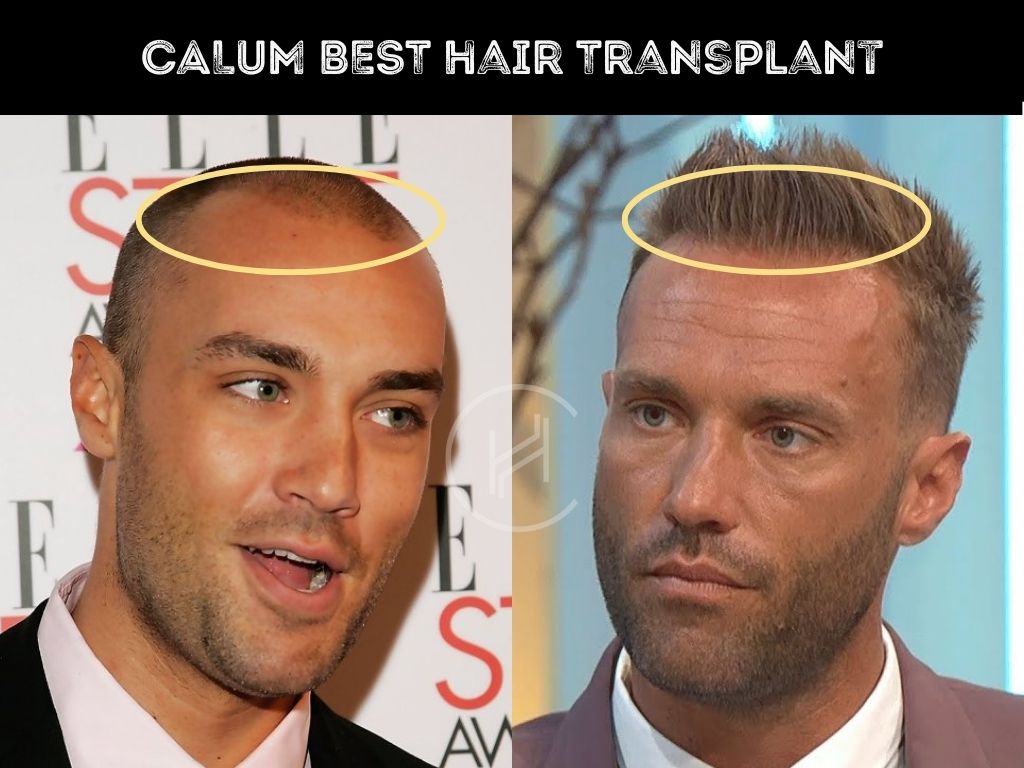 Hair Transplant Result Before and After Calum Best Difference