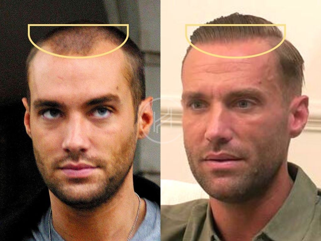 Hairline Calum Best After Hair Transplant