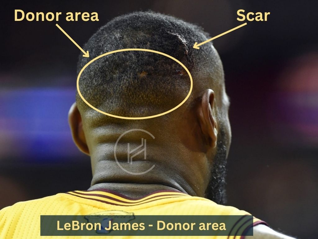 LeBron James Hair Transplant Scar and Donor Area