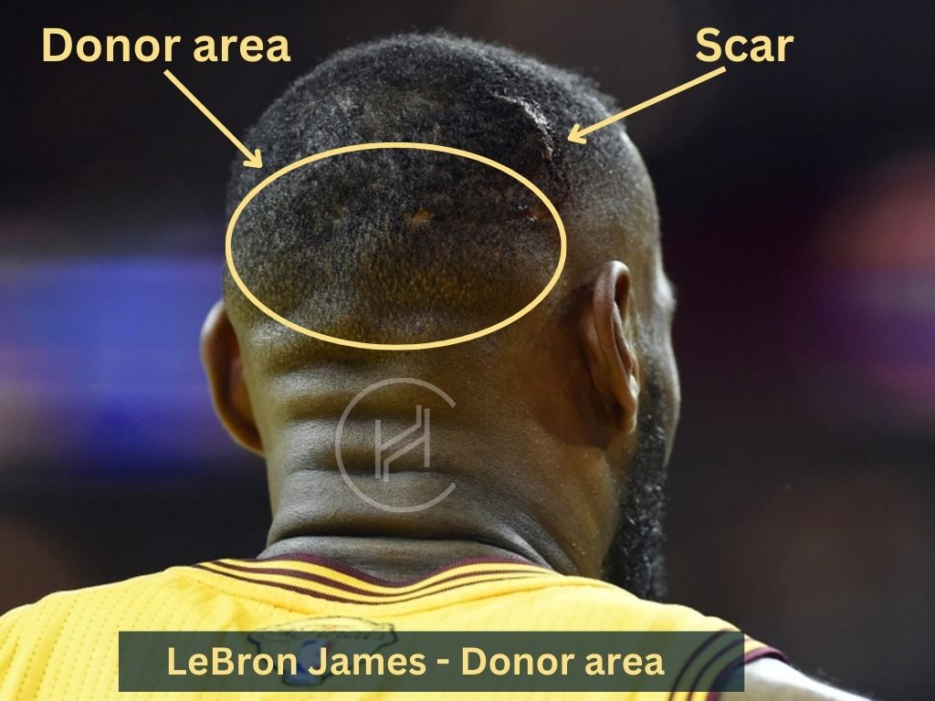 Lebron James Hair - Hair Transplant Analysis by Matt Dominance