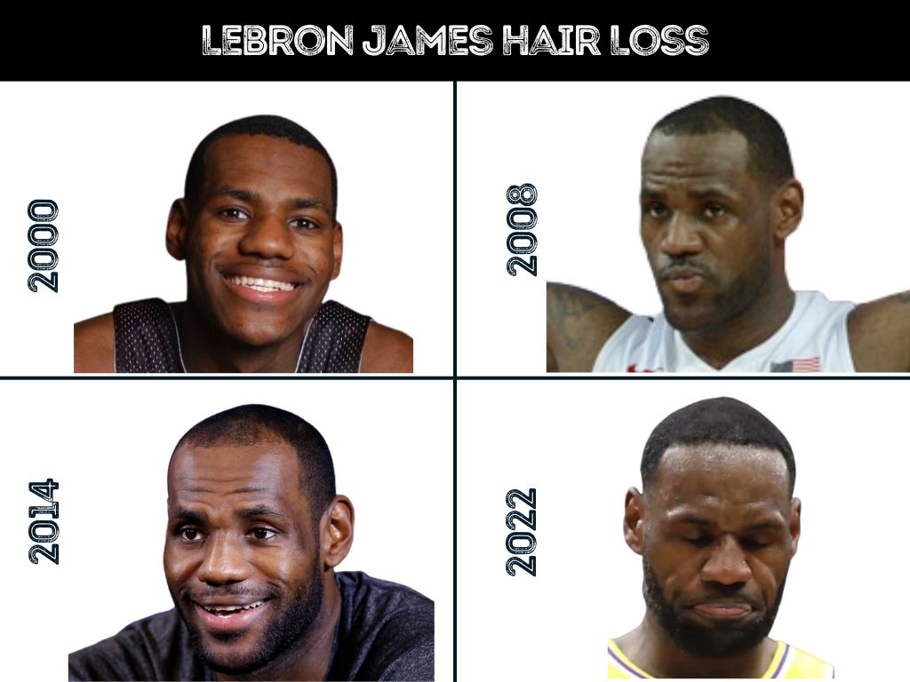 LeBron James hair loss throughout the years