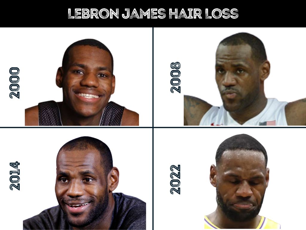 lebron hairline fixed