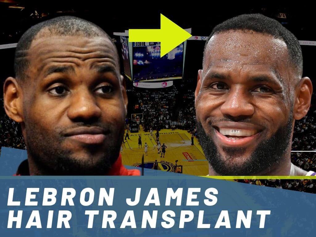 lebron hairline fixed