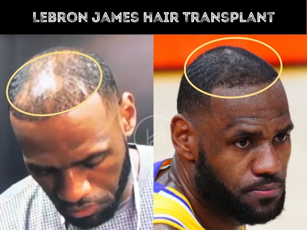 LeBron James hair transplant before and after result