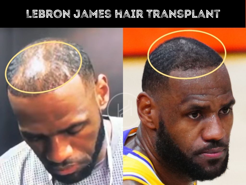 lebron hairline fixed