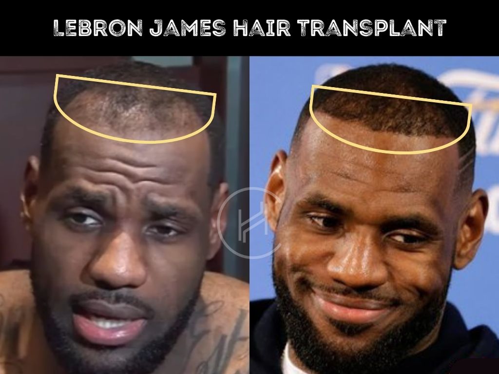 LeBron James hair transplant result before and after