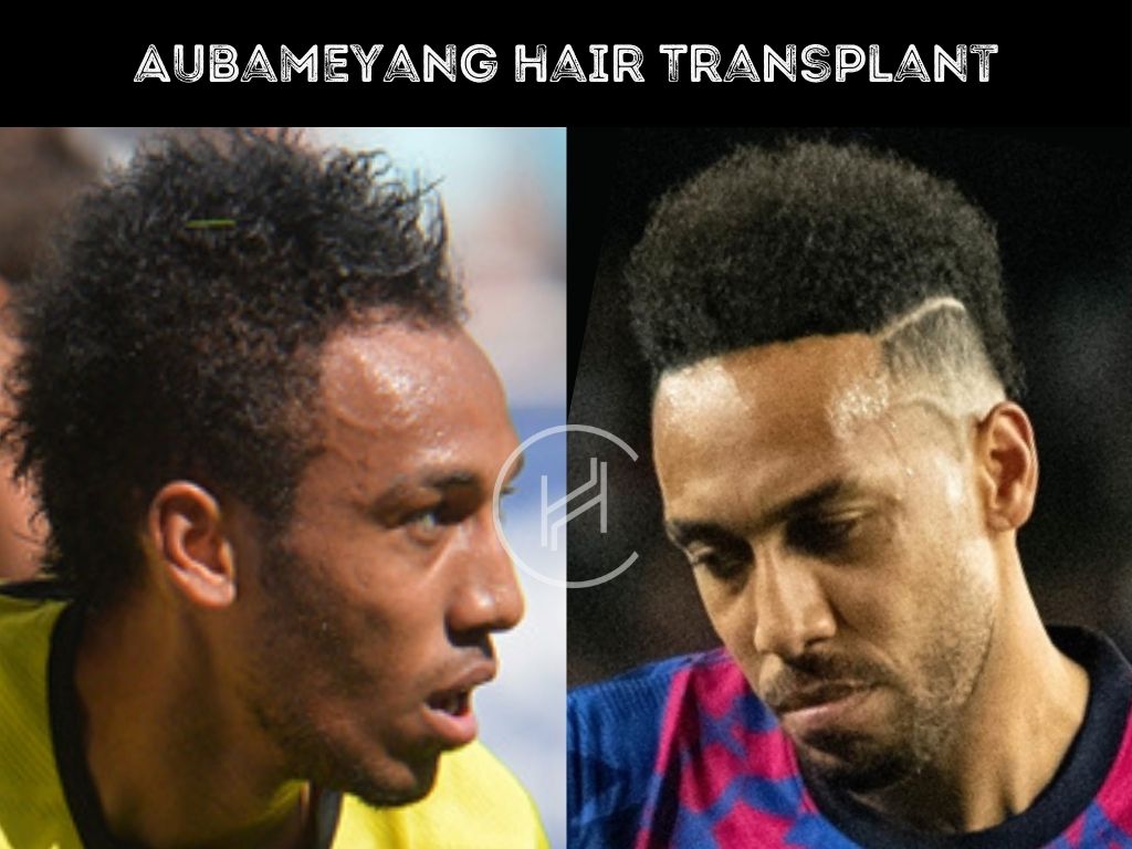 Pierre-Emerick Aubameyang Before After Hair Transplant