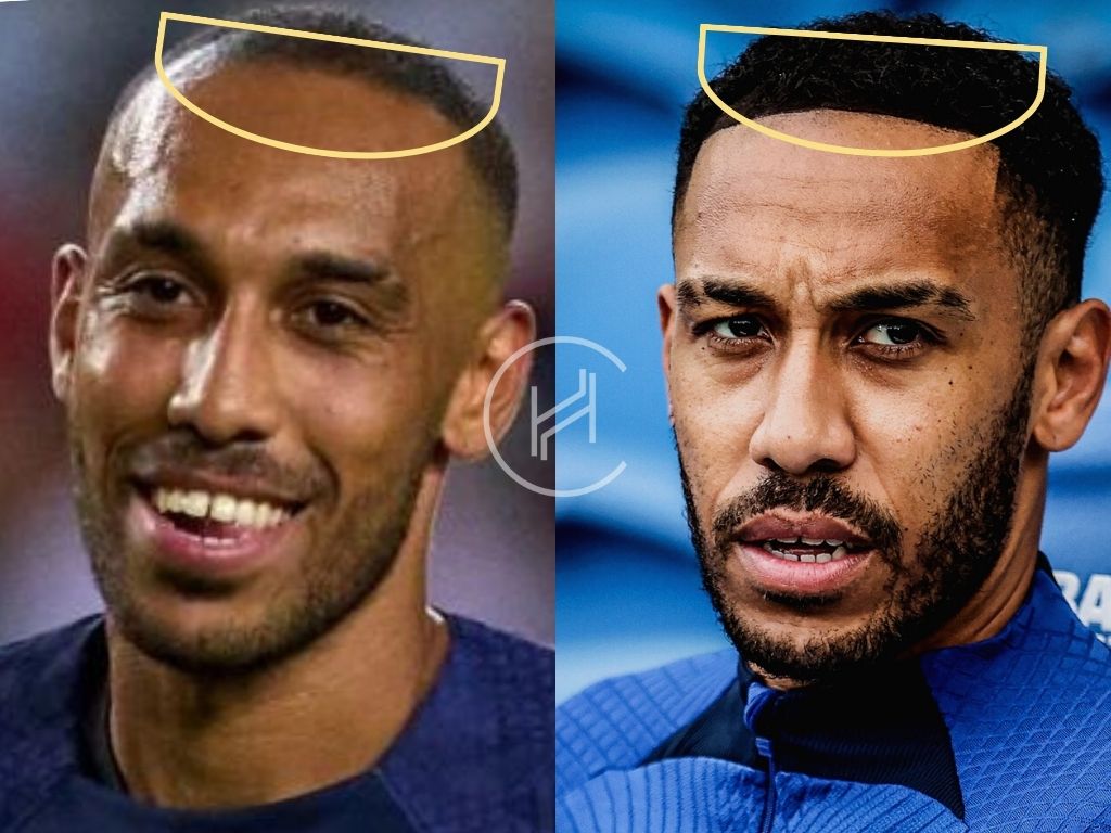 Pierre-Emerick Aubameyang Hair Transplant Hairline Before After Difference