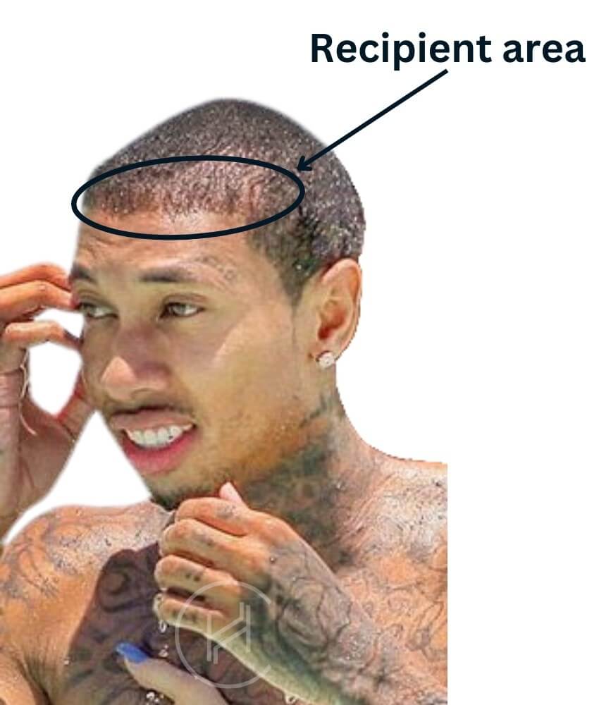 Recipient area of Tyga's hair transplant