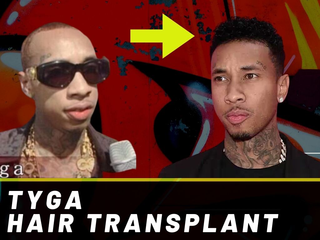 Tyga Hair Transplant Analysis Banner