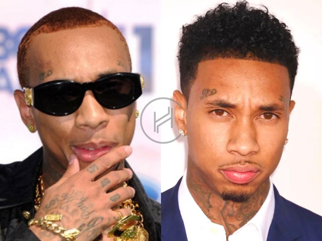 Tyga Hair Transplant Before After Photo