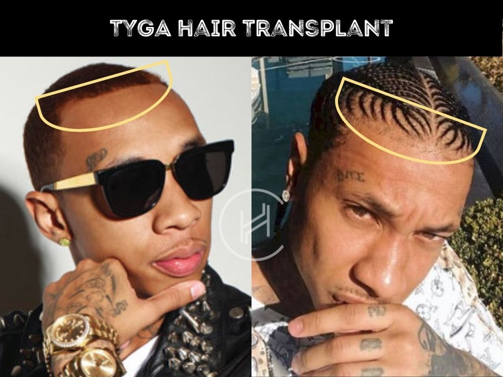 Tyga Hair Transplant Before and After