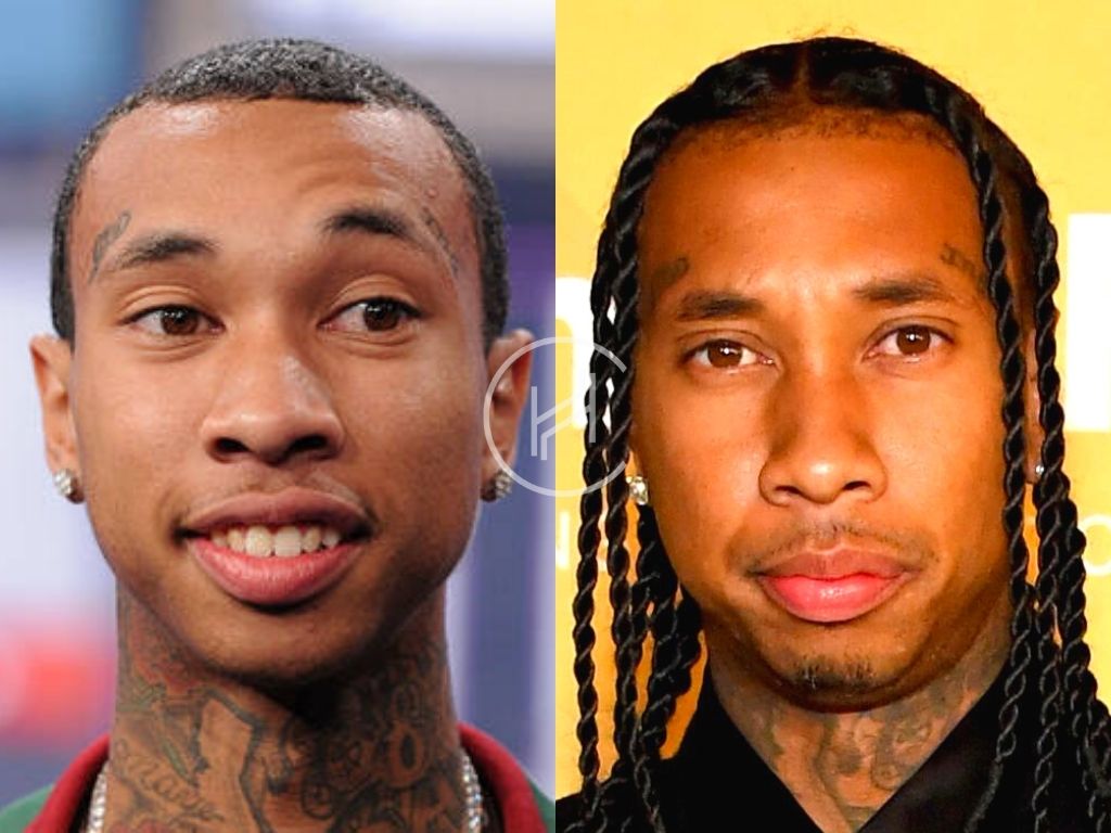 Tyga Hairline Before and After Hair Transplant