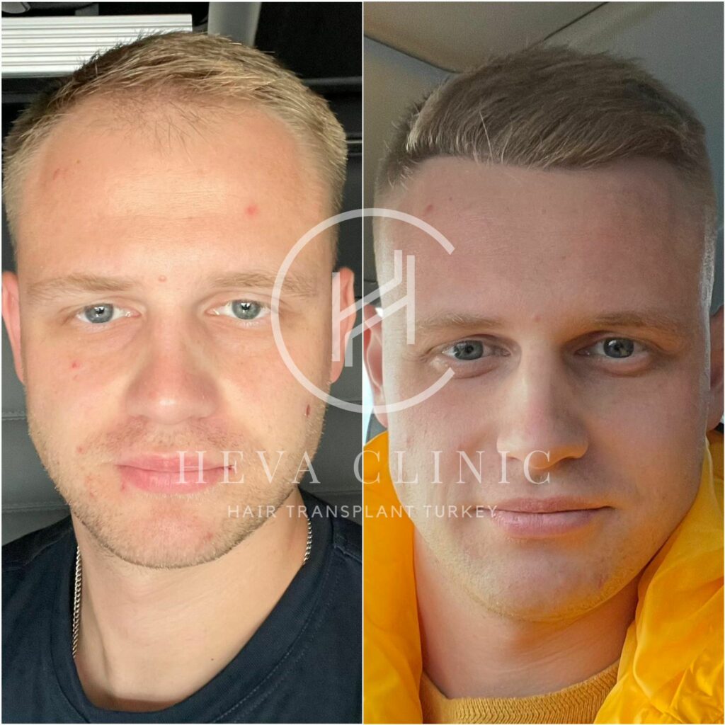 blonde hair transplant before and after result 3000 grafts