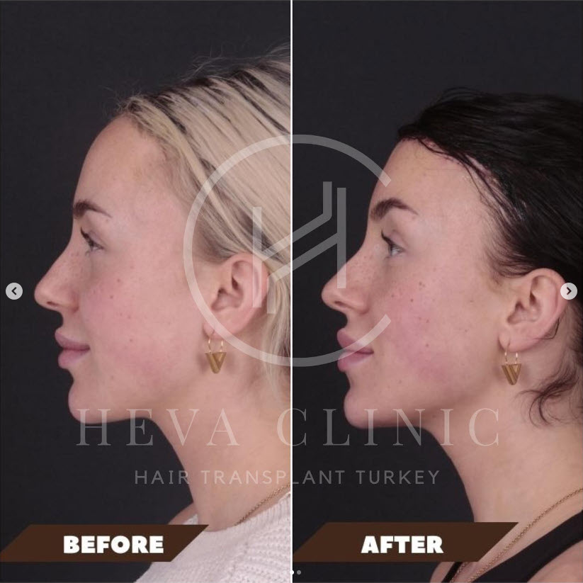 forehead reduction before and after result side angle