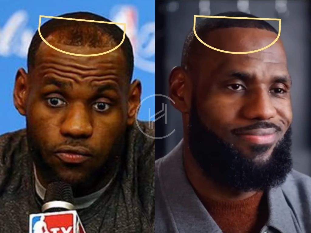 hair transplant before and after LeBron James basketball player