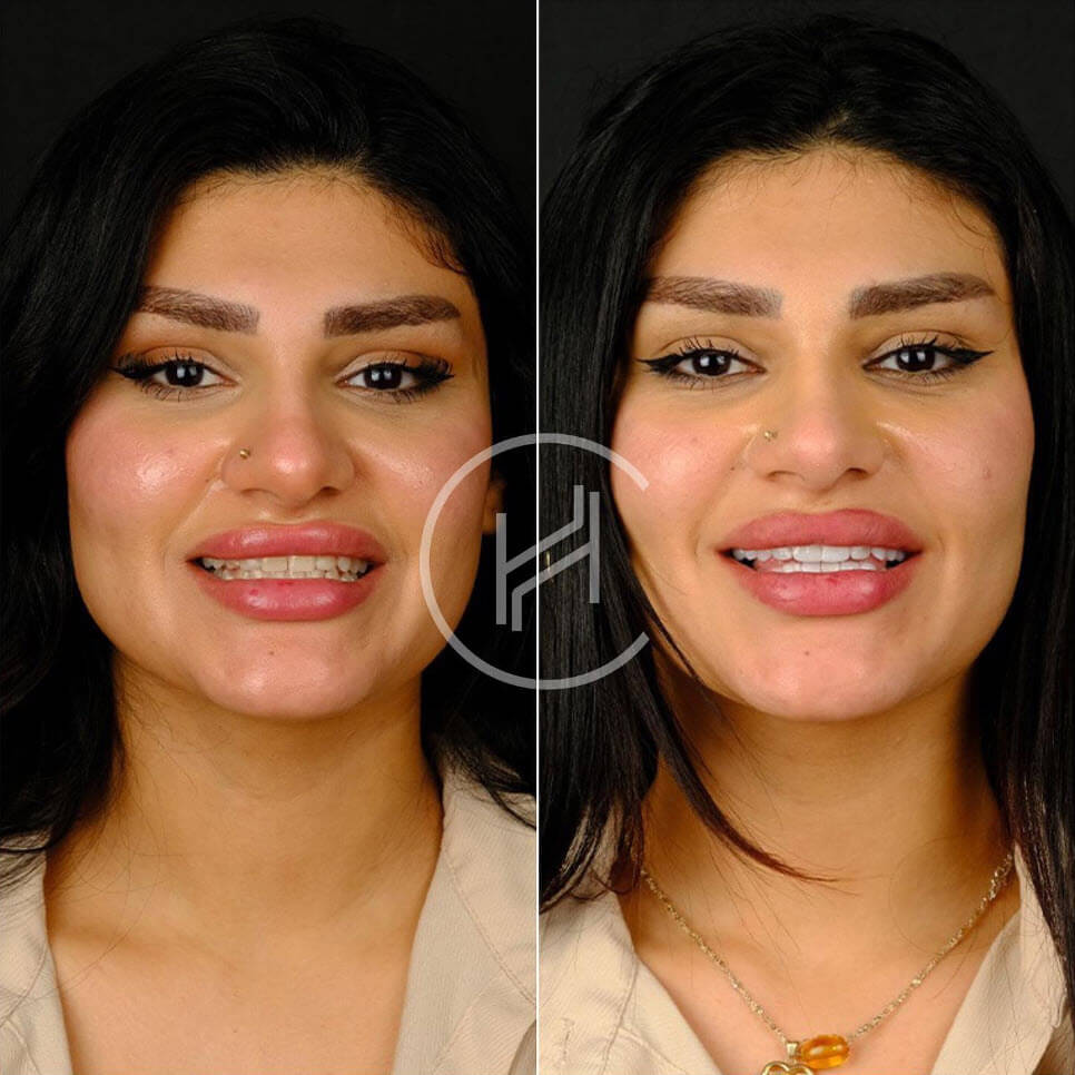 hollywood smile before and after at heva