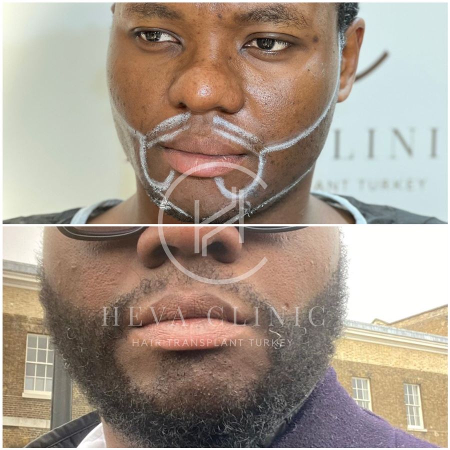 2800 grafts afro textured curly beard transplant result before after photo