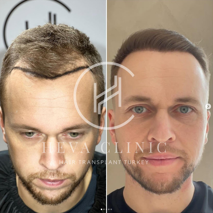 8 months 3200 grafts hair transplant before and after