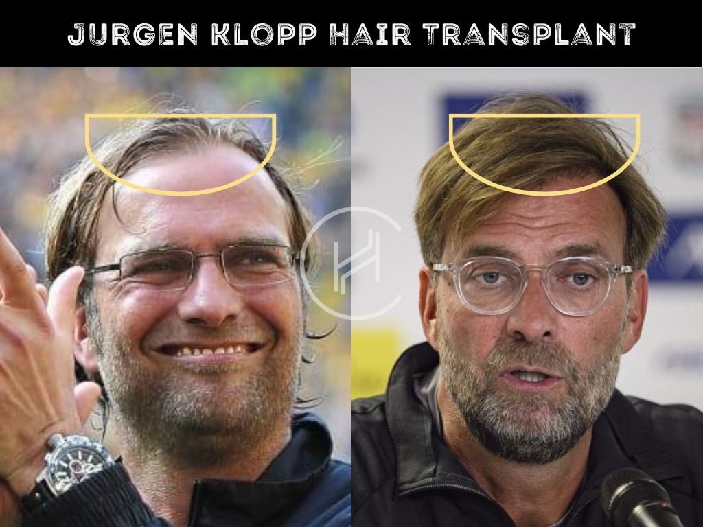 Hair Transplant Before and After Jurgen Klopp
