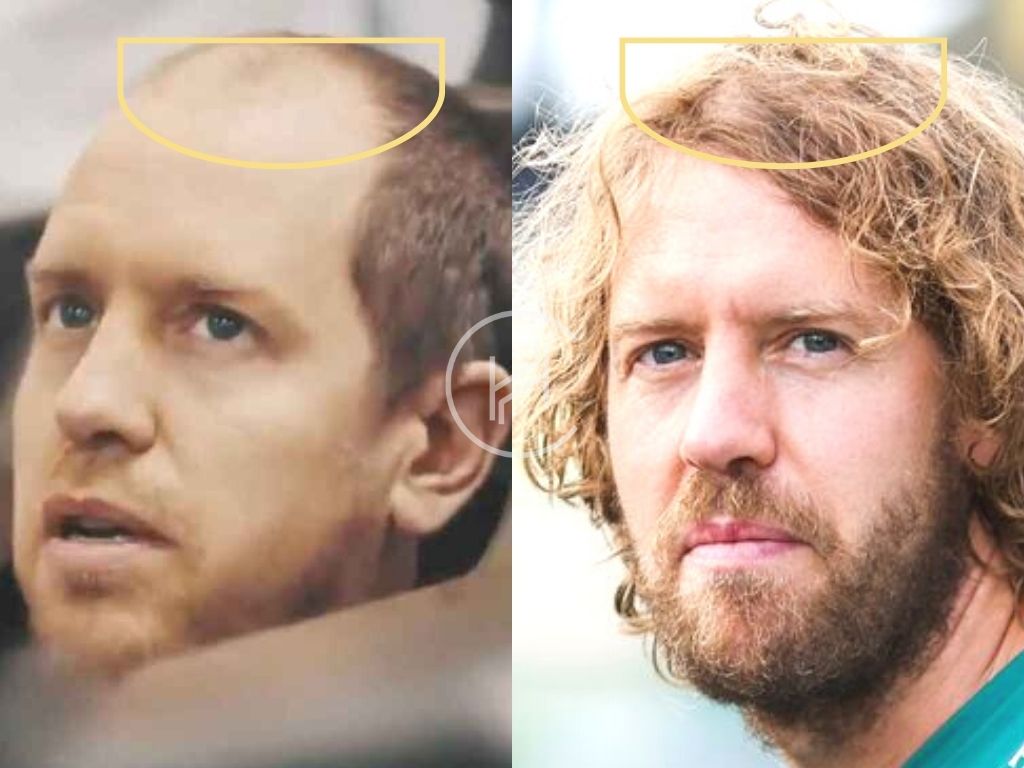 Hair Transplant Before and After Sebastian Vettel F1