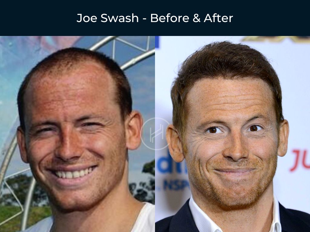 Joe Swash - Hair Transplant Before & After