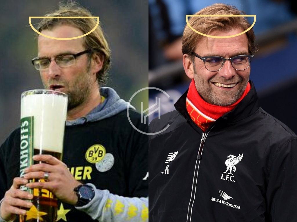 Jurgen Klopp Hair Transplant Before & After Result